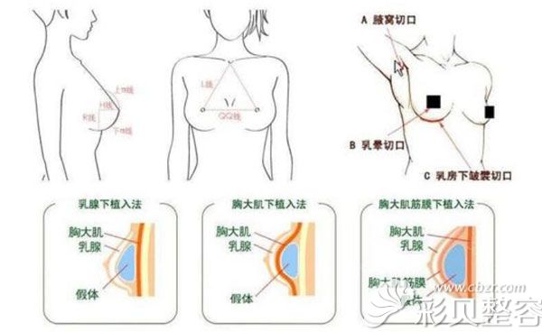 假体硅胶隆胸能保持多久