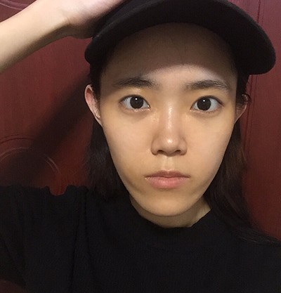 在重庆美圣美邦做完日式双眼皮，变身元气电眼