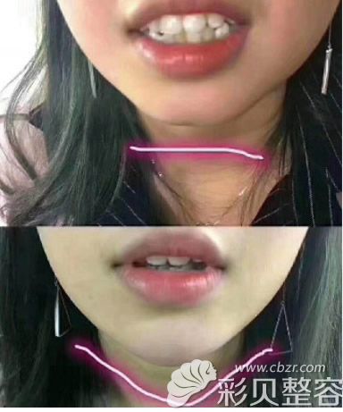 硅胶垫下巴前后对比照片 硅胶垫下巴前后对比照片