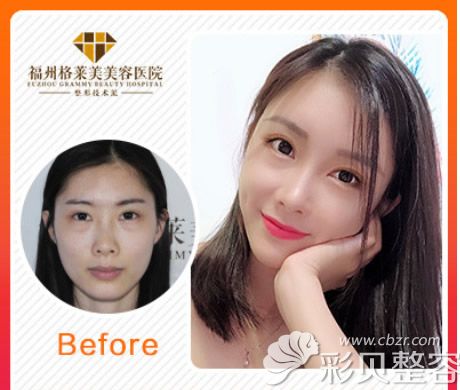 福州格莱美周秀峰院长全脸脂肪填充效果图片 福州格莱美周秀峰院长全脸脂肪填充效果图片