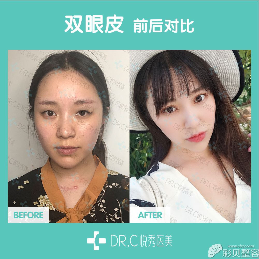 双眼皮5.jpg