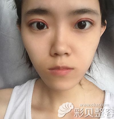 术后7天.JPG