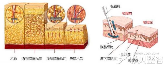 冯艳中医生分享吸脂手术的原理