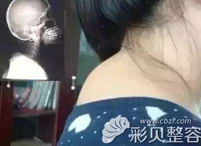 冯艳中医生分享脖子脂肪多形成富贵包