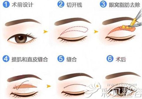 马医生做眼部整形手术步骤简易图