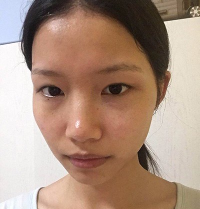 重庆也能做美美的日式双眼皮，变美就现在
