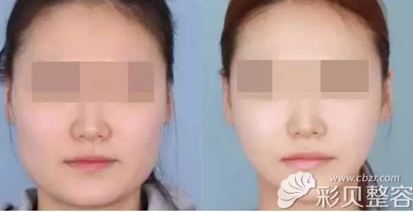 注射瘦脸针前后效果对比图