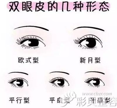 双眼皮的几种形态