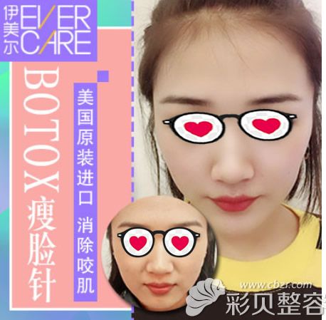 哈尔滨伊美尔王新东医生注射瘦脸效果好不好