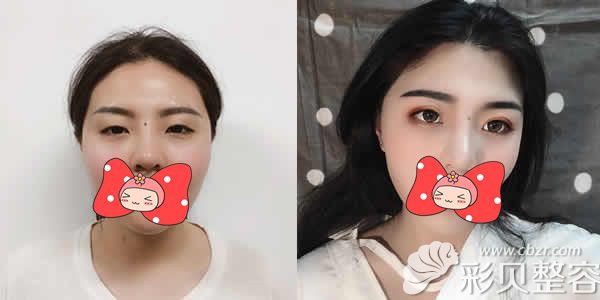 西宁时光整形王主任切开双眼皮+开眼角前后对比照片