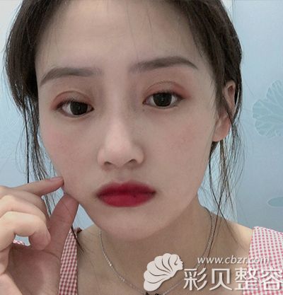 术后10天.jpg