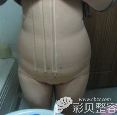 安宰贤腰腹吸脂第15天效果