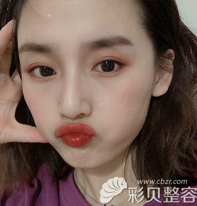 术后100天.jpg