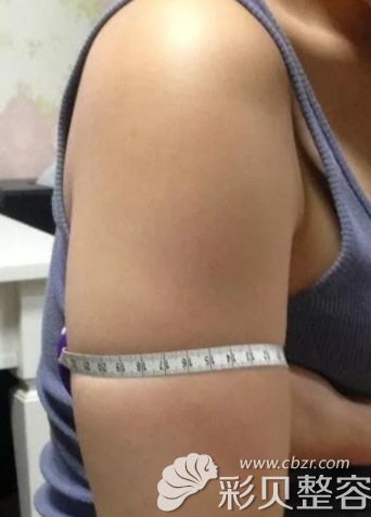 北京达美如艺整形美容门诊部国海军手臂抽脂前