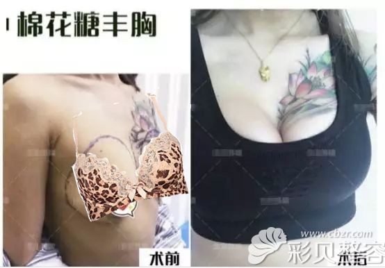北京韩啸棉花糖丰胸真人案例效果对比图