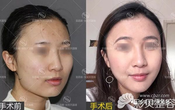 颌角长曲线截骨前后效果对比照片