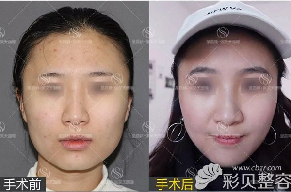 圣嘉新脸部磨骨一年后的恢复效果怎么样