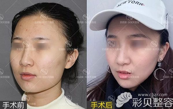 削骨瘦脸价格贵吗?效果好不好?请看我脸部磨骨前后对比图片