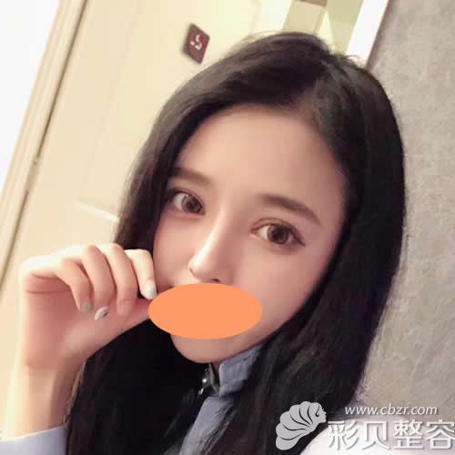 找北京彤美医疗李长赋做双眼皮隆鼻术后2个月