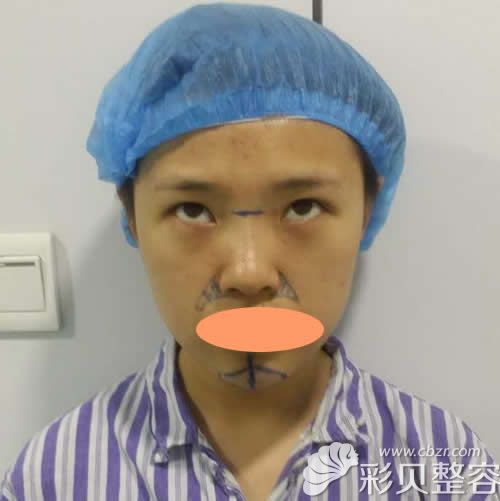 找北京彤美医疗李长赋做双眼皮隆鼻术前