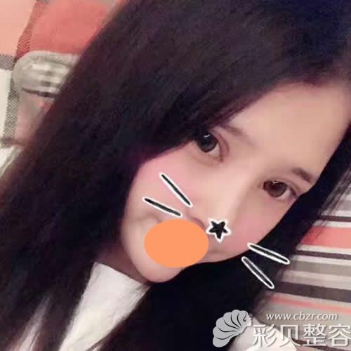 找北京彤美医疗李长赋做双眼皮隆鼻第25天