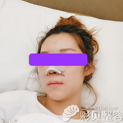 上海薇琳曹芳主任为我做鼻综合术后3天图片