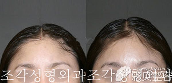 韩国雕刻宋龙泰做骨水泥填充头顶术前术后图片效果