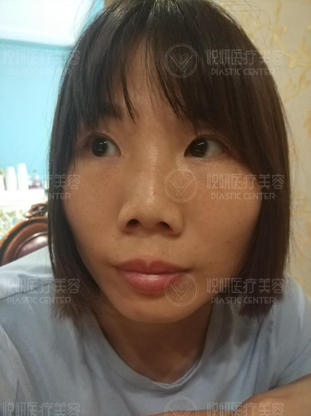 肋软骨隆鼻，翘挺美鼻术后即刻呈现