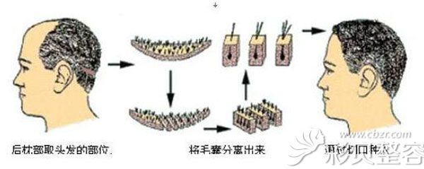 深圳华侨整形毛发种植过程图