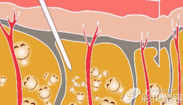 腹部吸脂示意图