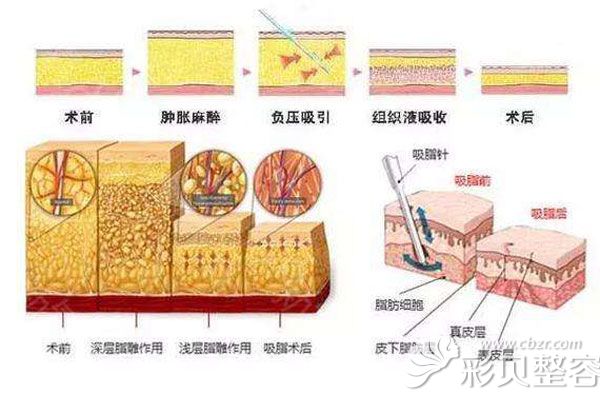 吸脂的过程介绍