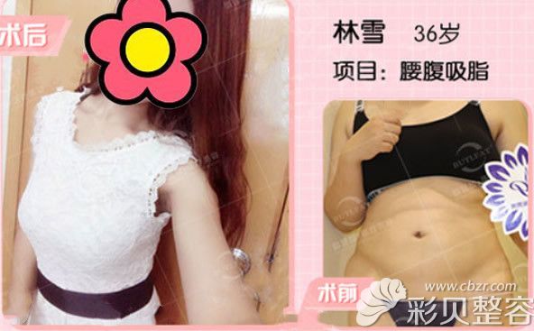 泉州脂管加邵起民腰腹吸脂案例 泉州脂管加邵起民腰腹吸脂案例