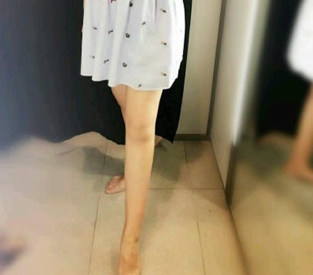 我都没敢信在沈阳汇美人做大腿吸脂4000ml腿围居然能瘦5厘米