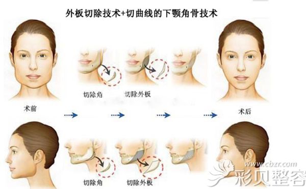 劈外板和长曲线下颌角一起做效果会更好