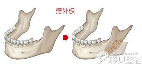 劈外板原理示意图