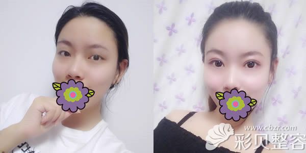 山西整形外科刘晋元为我做切开双眼皮前后对比效果 山西整形外科刘晋元为我做切开双眼皮前后对比效果
