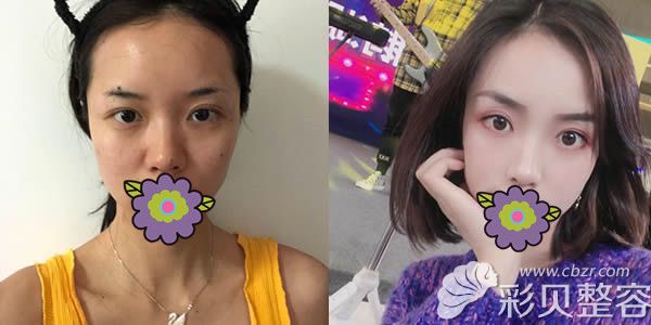山西整形外科刘晋元院长硅胶假体隆鼻真人案例效果 山西整形外科刘晋元院长硅胶假体隆鼻真人案例效果