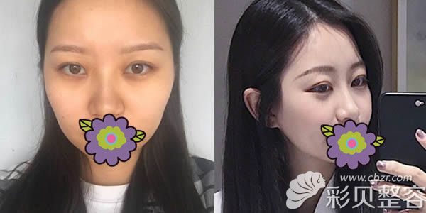 山西整形外科刘晋元自体脂肪丰全脸前后对比照片 山西整形外科刘晋元自体脂肪丰全脸前后对比照片