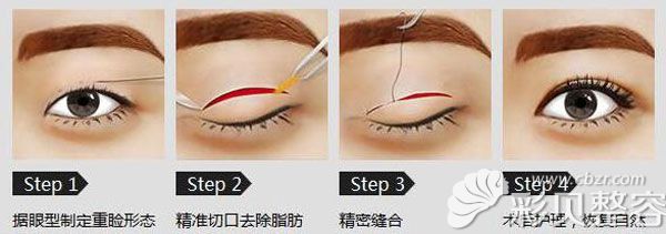 割双眼皮技术优势