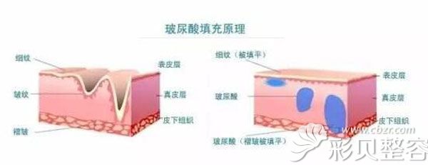玻尿酸填充的原理