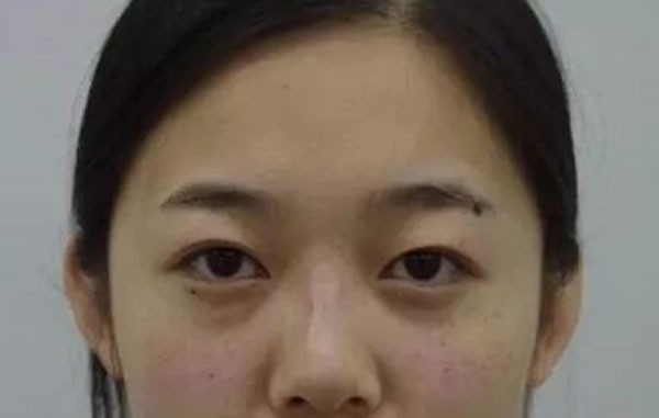 找沈阳安娜宝士丽汪方做双眼皮2个月很自然，感觉我赚大了