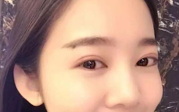 找沈阳安娜宝士丽汪方做双眼皮2个月很自然，感觉我赚大了