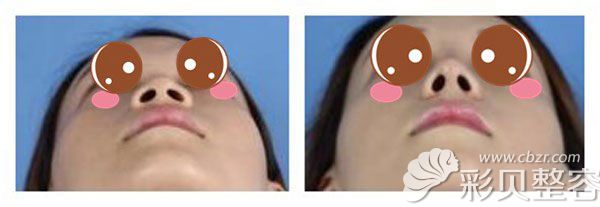 自体耳软骨延长鼻小柱案例效果对比图