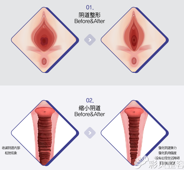韩国如妍阴道整形与缩阴模拟图