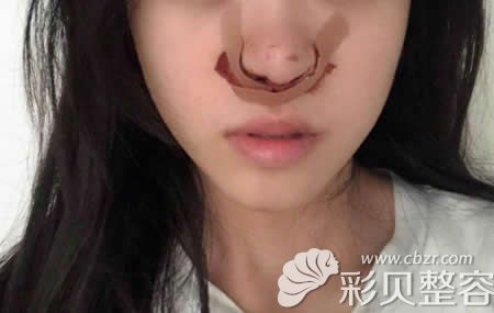 我找张家界依莱美张杰芳做鼻头鼻翼缩小术后即刻