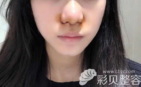 我找张家界依莱美张杰芳做鼻头鼻翼缩小术后3天效果