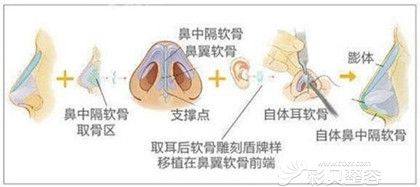 鼻综合手术过程