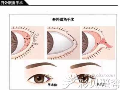 开外眼角的手术原理