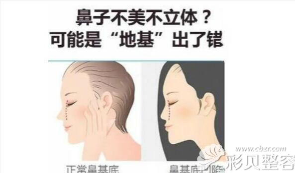 鼻基底凹陷填充有多重要介绍 鼻基底凹陷填充有多重要介绍