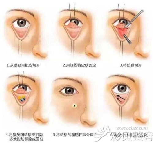 眶隔脂肪释放术原理